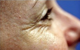 Arcránctalanítás Botulin toxinnal